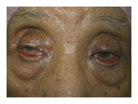 Case 4 Had Bilateral Lower Eyelid Cicatricial Ectropion A And