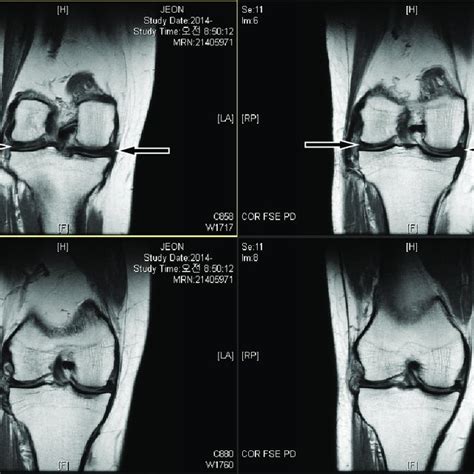 Left knee MRI of case 4 | Download Scientific Diagram