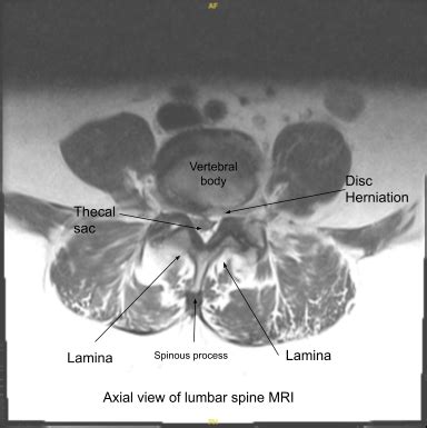 L Laminectomy And Discectomy Complete Orthopedics