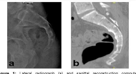 Sacrum Coccyx Fracture