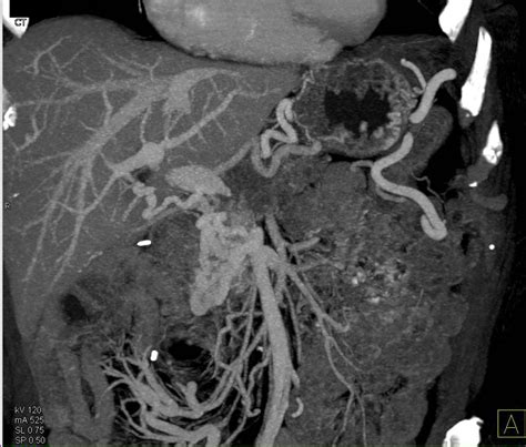 Pancreatic Cancer Encases And Occludes The Portal Vein Smv Confluence