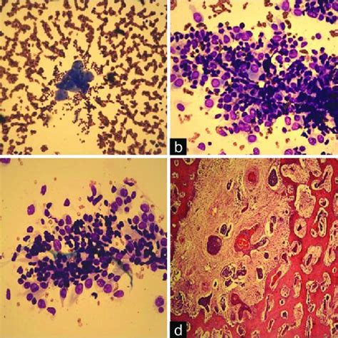 A Pap Stain ×400 Showed A Group Of Mature Squamous Cells B Geimsa Download Scientific