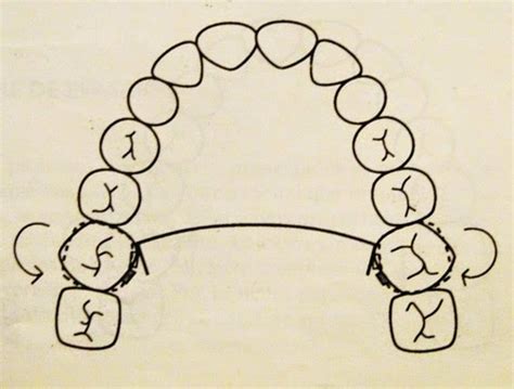 Características De La Clase Ii Biomecánica De La Corrección De Clase Ii