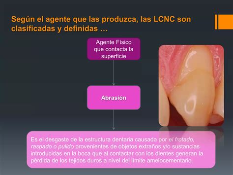 Clasificaci N De Las Lesiones Cervicales No Cariosas Ppt