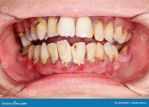 Tartar stock photo. Image of gums, tooth, tartar, material - 34464548