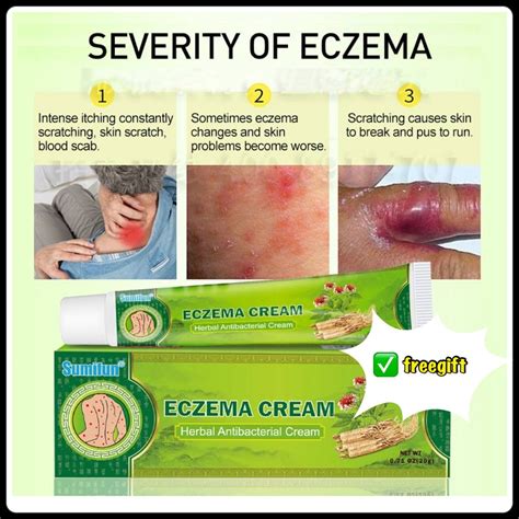 Ubat Gatal Kulit Ekzema Berkesan Eczema Ubat Herba Cina Psoriasis