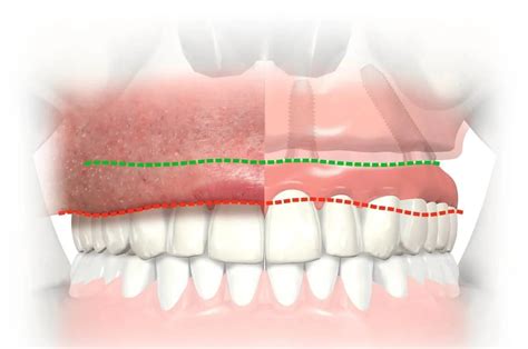 All On 4 Dental Implants Dental Implant Clinic Maxillo 3 Lacs