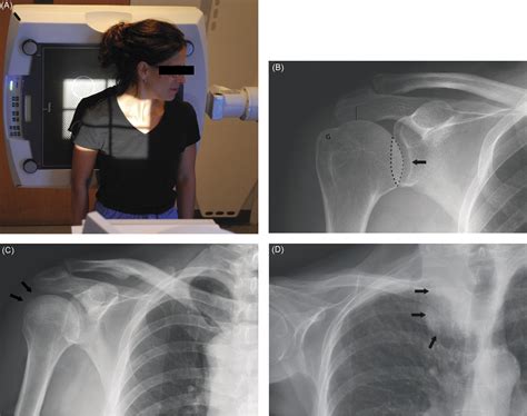 Shoulder X Ray Positions