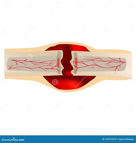 2 Stage Of Healing Bone Fracture. Formation Of Callus. The Bone ...