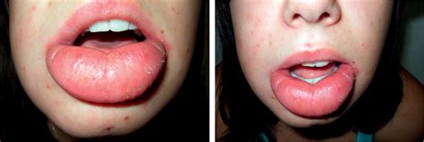 Canker Sore Lip Swollen