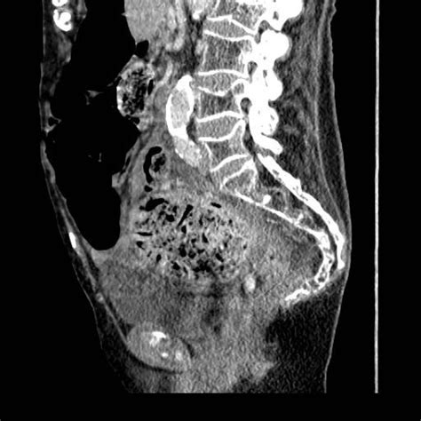 Stercoral Perforation Due To A Faecaloma Eurorad