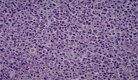 H&E 100x, cervical lymph node biopsy section showing the appearance of ...