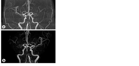 Magnetic Resonance Angiogram Showing Pre Procedure Occlusion Of The