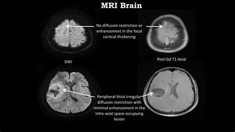 No diffusion restriction or enhancement in the focal cortical thickening | Download Scientific ...