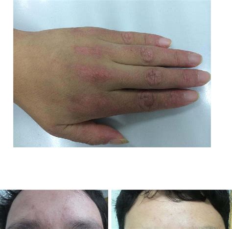 Figure From Narrowband Intense Pulsed Light Treatment For Refractory