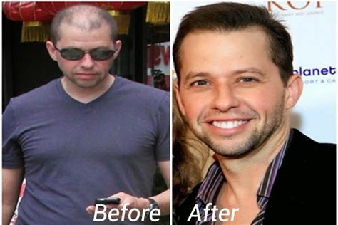 Jon Cryer Hair Transplant