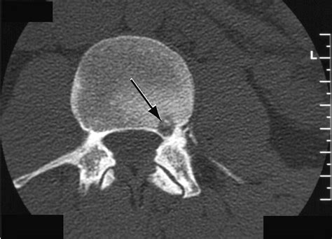 Technical Considerations In Ct Guided Radiofrequency Thermal Ablation