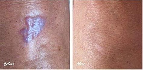 Science Of Skin Solution For Scars Clinically Proven Active Scar Cream