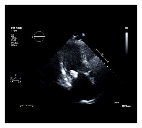 Transthoracic echocardiogram views. Four standard views that show a ...