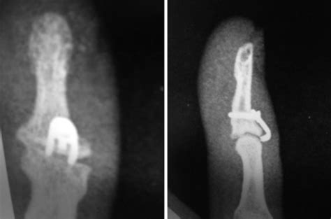 Radiografia Pós‐operatória Na Incidência Anteroposterior E Perfil Que Download Scientific