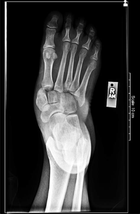 Lisfranc Fracture Dislocation Radiograph Pre Reduction Frontal View Download Scientific