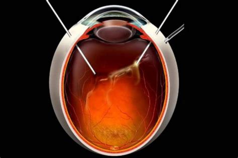 Vitrectomia Via Pars Plana Hospital De Olhos E Vis O Do Par Hovp