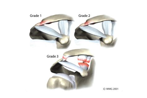 Acromioclavicular Joint Pain Shoulder Pain Complete Physio