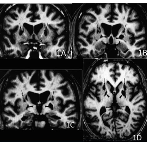 | 3D volume rendering of basal ganglia lesion. The lesion is ...