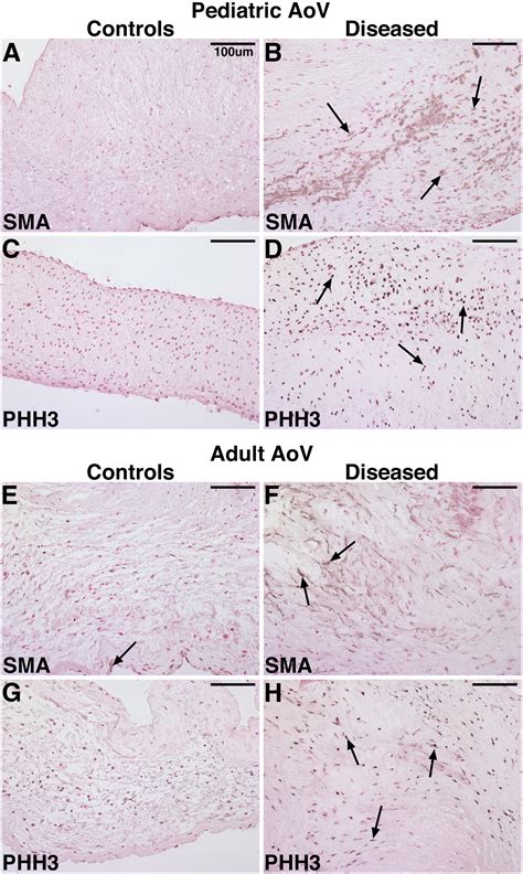 Differential Expression Of Cartilage And Bone Related Proteins In