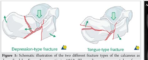 Figure 1 From Congenital Unilateral Hypertrophy Of The Foot Intrinsics A Rare Case And Review