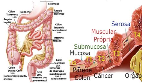 Clínica Factum Cirurgia do Aparelho Digestivo Pólipo e Câncer Colorretal