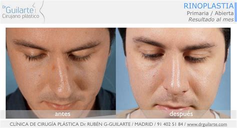 Rinoplastia Tabique desviado Solución SEPTOPLASTIA