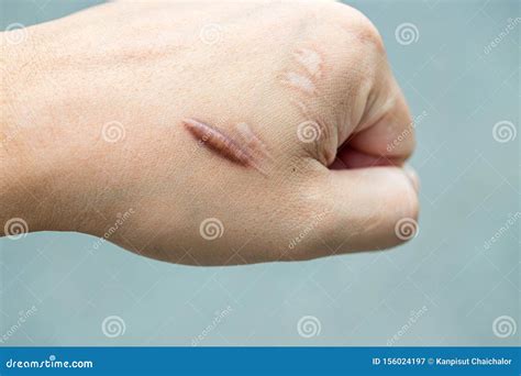 Keloid Scar Hypertrophic Scar On Man Hand Skin After Accident Keloidal