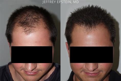 Hair Transplants For Men Photos Miami Fl Patient47570