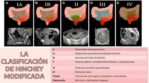 Enfermedad Diverticular Del Colon Manifestaciones Ppt