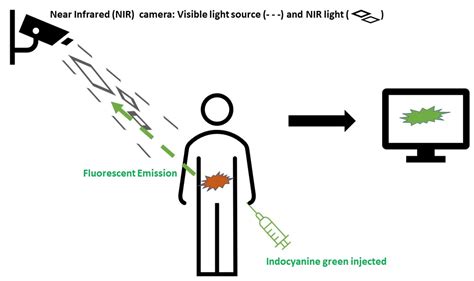 Jcm Free Full Text Indocyanine Green Fluorescence Guided Surgery In