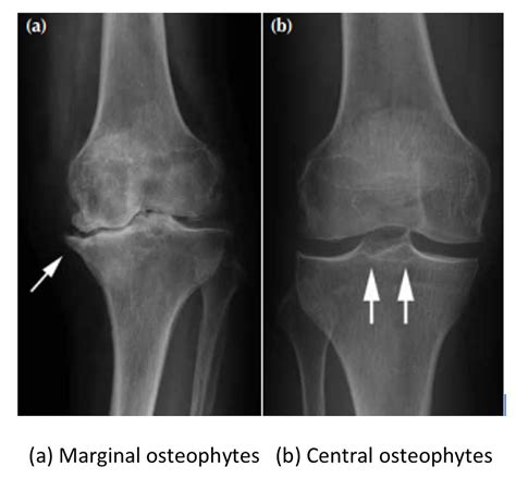 Bone Spur Osteophyte