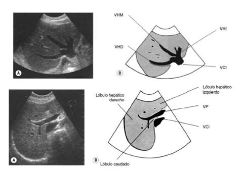 Ecografía normal de hígado y Ecografía Doppler de Vasos Hepáticos