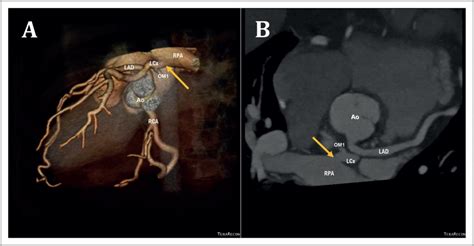 anomalous origin   circumflex coronary artery