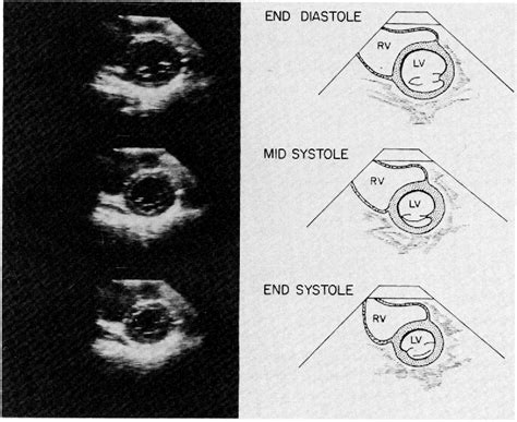 Figure From Interventricular Septal Configuration As A Predictor Of