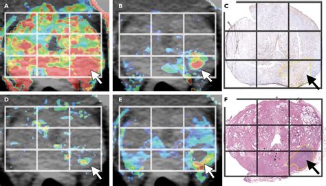 Perfusion Mdct Of Prostate Cancer Correlation Of Perfusion Ct