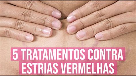 Estria Vermelha Como Tratar - 5 Melhores Tratamento para Estrias Vermelhas - YouTube