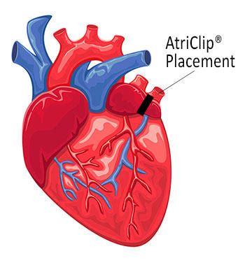 Left Atrial Appendage (LAA) Closure | Froedtert & MCW