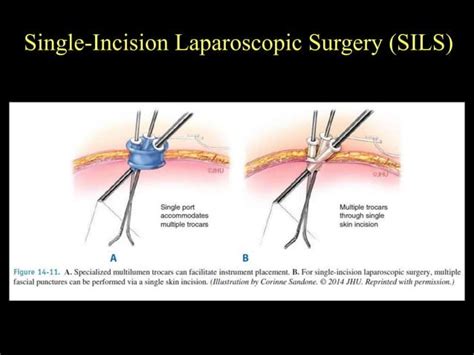 Minimal Invasive Surgery Ppt