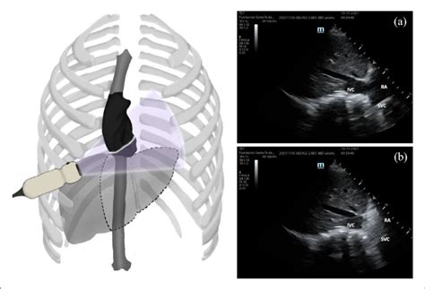 Transhepatic Right Heart Ultrasound A Visualization Of Inferior And