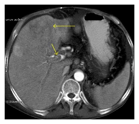 Portal Vein Thrombosis In A Patient With Hcc Complicating Hepatic