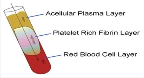 Platelet Rich Fibrin A Promising Regenerative Material Journal Of