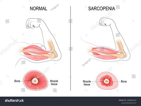 Sarcopenia Age Related Muscle Atrophy Royalty Free Stock Vector