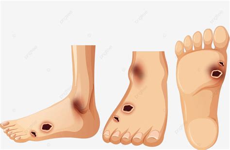 Human Foot With Diabetic Diabetes Treatment Picture Vector Diabetes