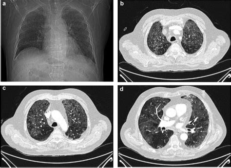 How To Diagnose And Treat A Patient Without Human Immunodeficiency Virus Infection Having